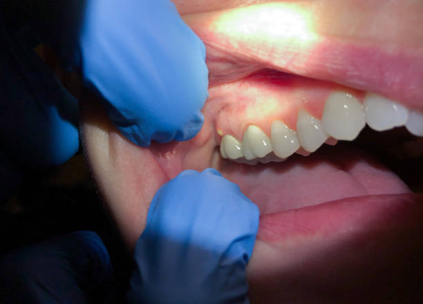 Best Knocked-Out Tooth Emergency  in Stonewall, MS