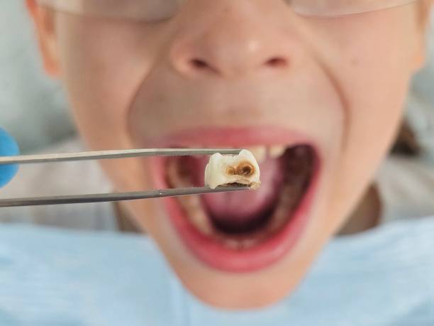 Best Cracked Tooth Emergency Dentist  in Stonewall, MS
